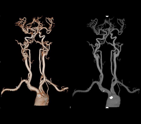 CT Angiography