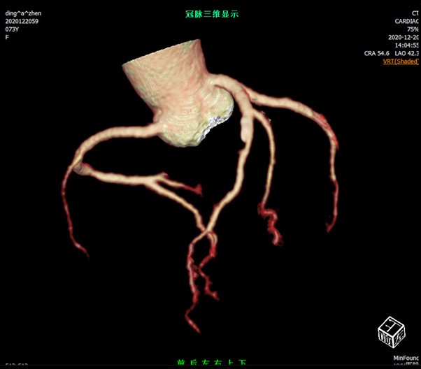 Coronary Analysis