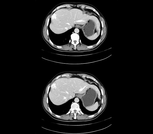 Abdomen Enhancement Scan